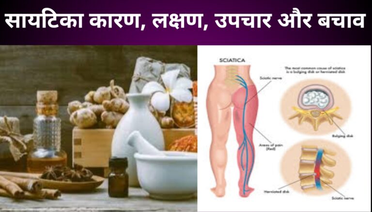 sciatica-karan-lakshan-upchar-aur-bachav