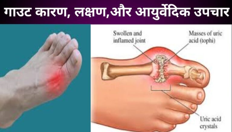 Gout-karan-lakshana-aur-ayurvedic-upchar