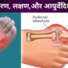 Gout-karan-lakshana-aur-ayurvedic-upchar